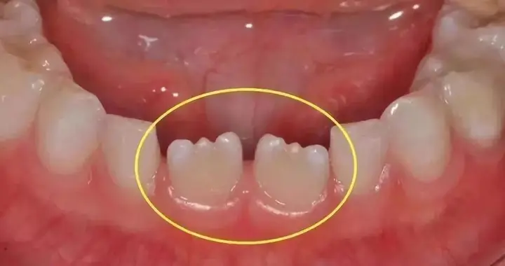 小孩牙齿为什么呈锯齿状？