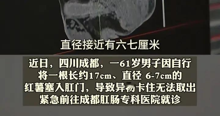 红薯塞入身体某器官的男子怎么样了