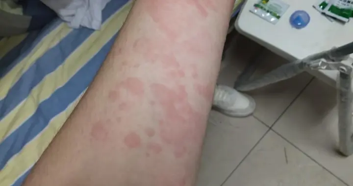 常年起红斑风团还要折磨多久？慢性荨麻疹究竟该怎么吃药调理？