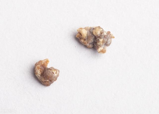 结石不能吃什么