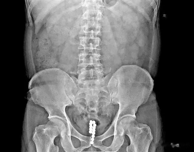 13颗钢珠卡爆膀胱！六旬老汉深夜急诊哭嚎：快救救我！