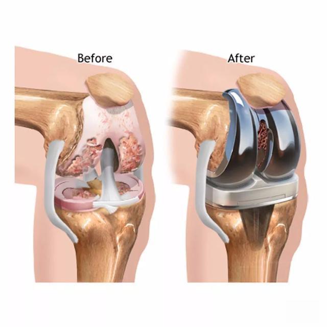 运动|决定做膝关节置换术前，您需要知道什么