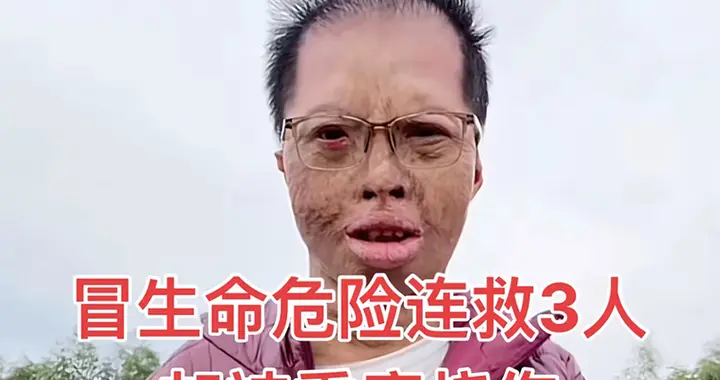 烧伤哥胡亚武生活窘迫，直播带货无人问津，别让好人凉了心