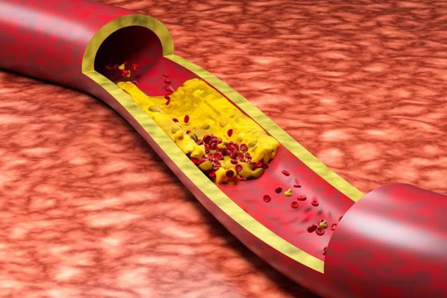 体检发现低密度脂蛋白超标的人，尽量少碰这3种食物，了解一下