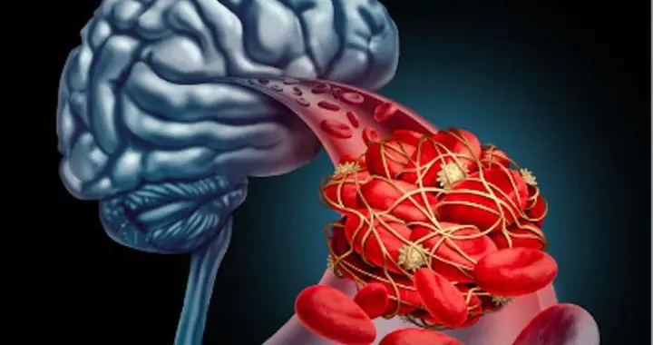 脑梗塞发作时，这些症状别忽视，记住"FAST"原则，5秒快速识别