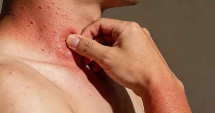 皮肤发红瘙痒？中医提醒：别大意！或是风热型皮疹的预警信号