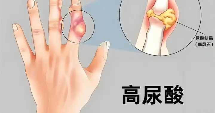 医生提醒：5种促尿酸排泄的食物一定要多吃！