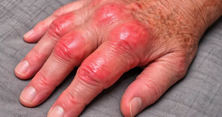 关节痛、肌肉酸、跌打扭伤都有？蒿白伤湿气雾剂：喷一喷快速止痛