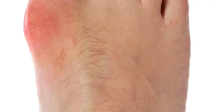 人不会平白无故得痛风！医生强调：易得痛风的人，多半有4个共性