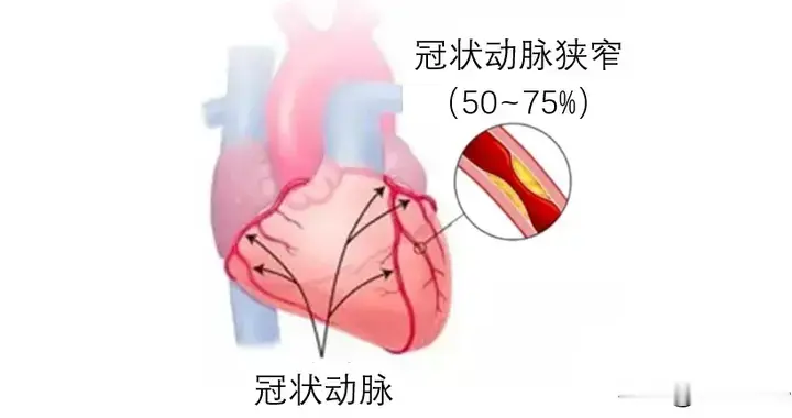 心梗来临前，身体会提前"报警"！这5个信号，很多人当成了累