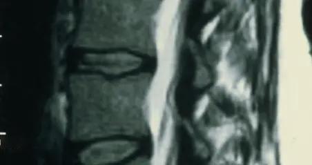 腰椎间盘突出，为何躺硬床更好？