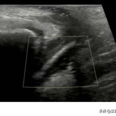 正直风铃：7岁女孩反复阴道炎好几个月，药