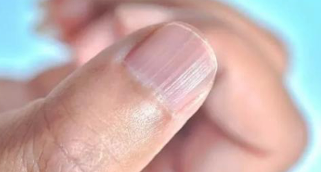 指甲上有竖纹？医生提醒：若指甲有这4种异常，要多注意