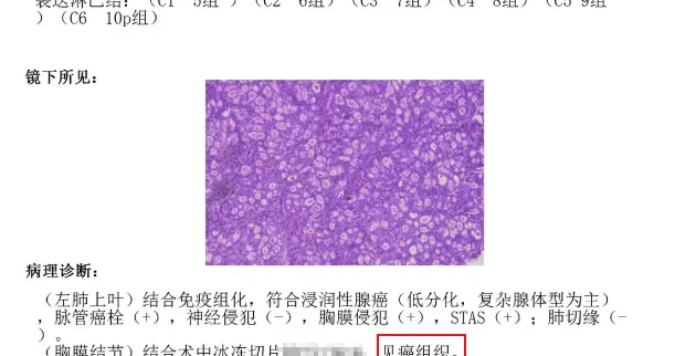 48岁浸润性肺腺癌，低分化，淋巴转移——病理报告解读