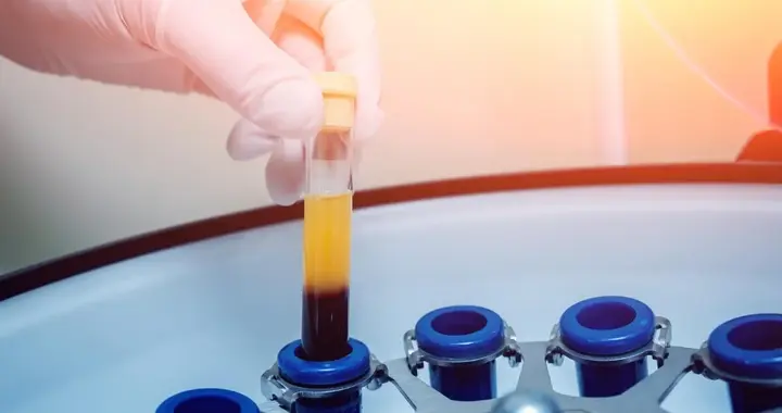 自体血源性干细胞（ABSCs）联合生长因子治疗中重度阿尔茨海默病的疗效