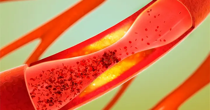 查出颈动脉斑块，离脑梗有多远？医生：关键看这几个指标！