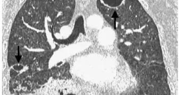 20岁男生肺被“啃”出10多个空洞