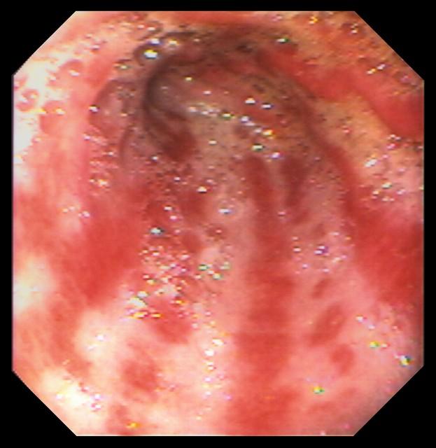 仅29岁的小伙，因一年近300次的外卖患胃窦腺癌