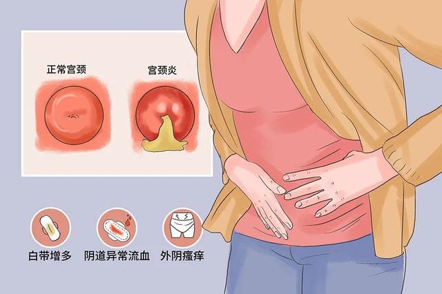 妇科小偏方：治疗慢性宫颈炎，大有用处！