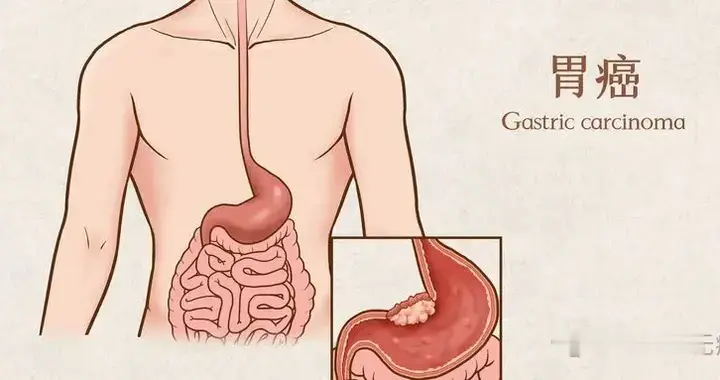 肿瘤完全缓解超60周！国研CAR-T疗法给晚期胃癌迎来强效新武器