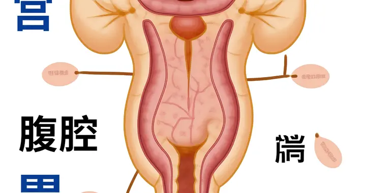 46岁女子腹痛3天竟是节育器异位