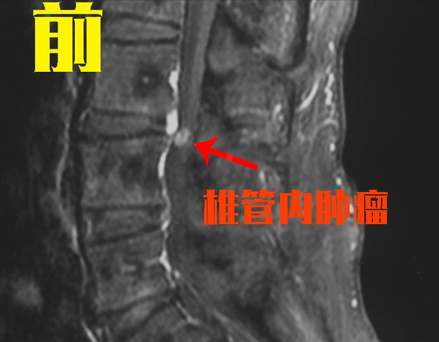 查出腰椎管里长肿瘤，但是特别小，这种情况还用马上手术吗？