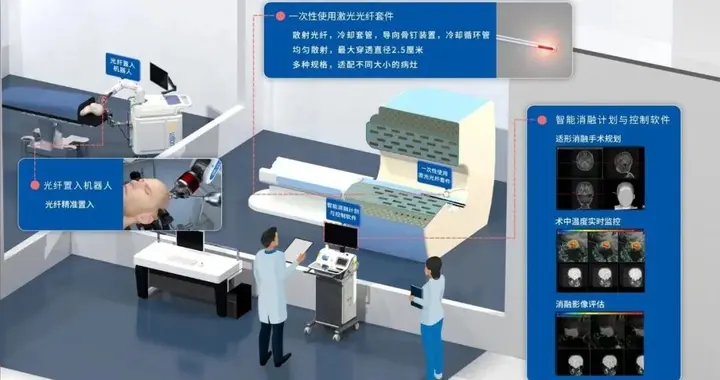 激光热凝（LITT）治疗癫痫的效果如何？