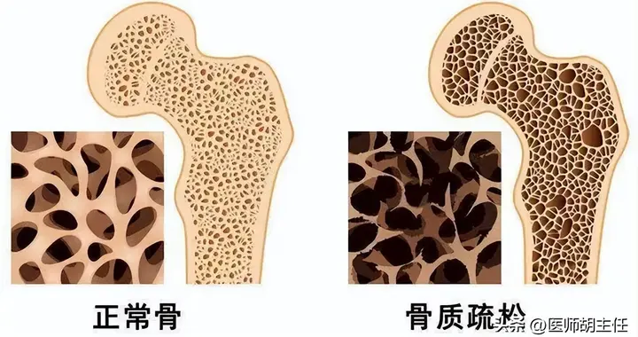 原来骨头汤并不补钙！医生直言：真正补钙的 3 种食物，别吃错了
