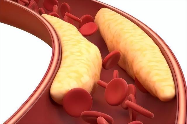 高血脂与睡觉有关?医生多次强调:高血脂人,睡觉切记“2不要”