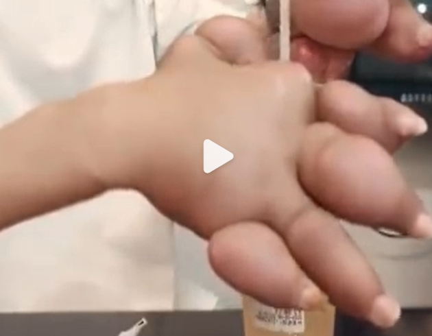 尿酸高当心痛风。孩子出现尿酸高，哪些食物要少吃？