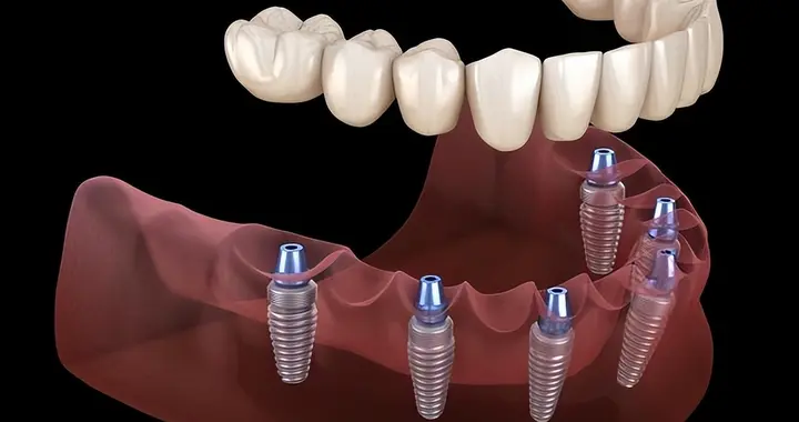 日本叫停种植牙？种牙潜藏的风险与后遗症，一次为你讲明白清楚