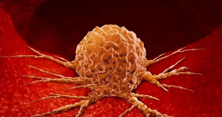 上海交大发现：体内有恶性肿瘤的人，身体一般或可能有4个表现