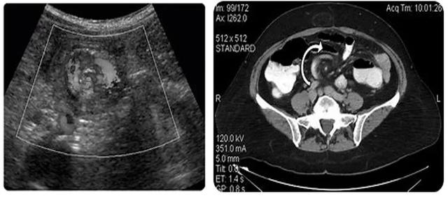急腹症之小肠扭转有哪种诊断提示？（漩涡征）