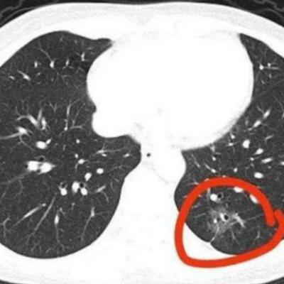 曾老师杂谈：狡猾的肺癌！研究发现：身体若