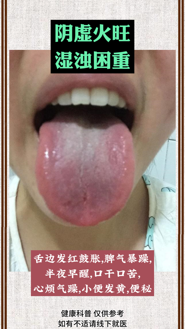 漆主任男妇科——舌诊实战经验分享：阴虚火旺，痰湿重、脾胃湿热