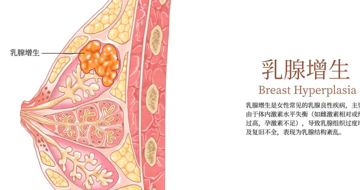 科学应对乳腺增生：告别焦虑，从了解开始