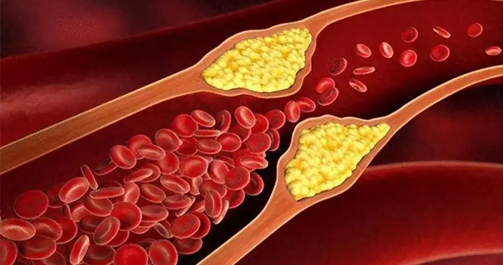 甘油三酯偏高不能吃榴莲？医生建议：血脂高，3种水果建议少吃