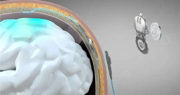 清华教授的脑机接口，让瘫痪的人动起来了