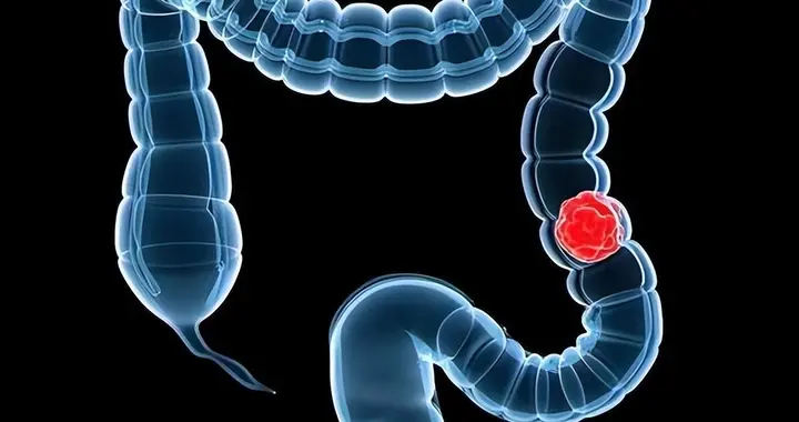 便血就是痔疮？别大意！也可能是结直肠癌，5类人群尽早开始筛查