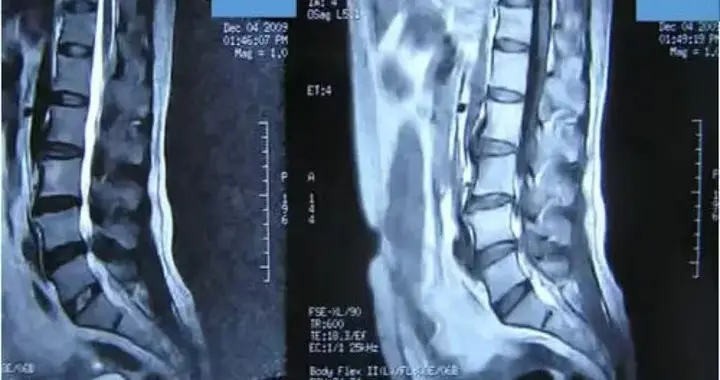 行医40年，我直言不讳：腰椎间盘突出，中药到底能不能“治好”？