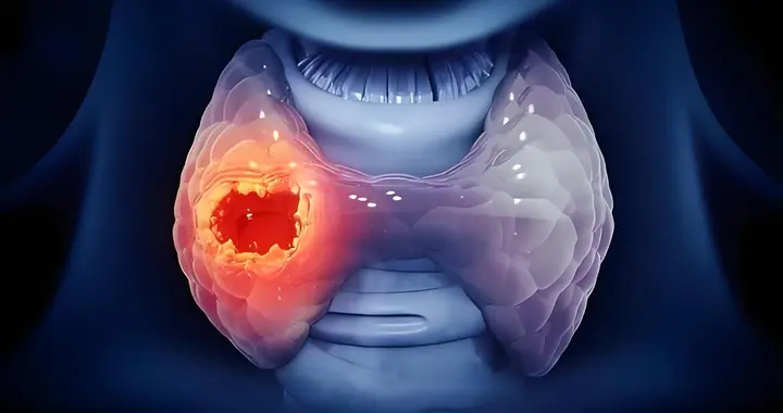 原来它就是诱发甲状腺结节的“元凶”，医生提醒：知道了就要躲开