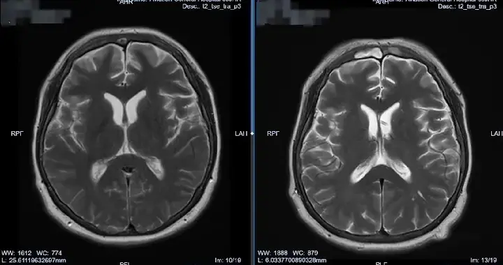 生命之战：肖庆主任精准引流技术破解真菌颅内感染困局