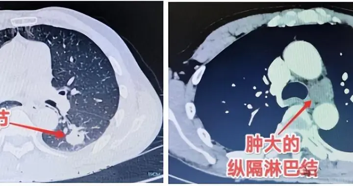 38岁男子嗓子不舒服，竟查出癌症！这些“信号”千万别忽视