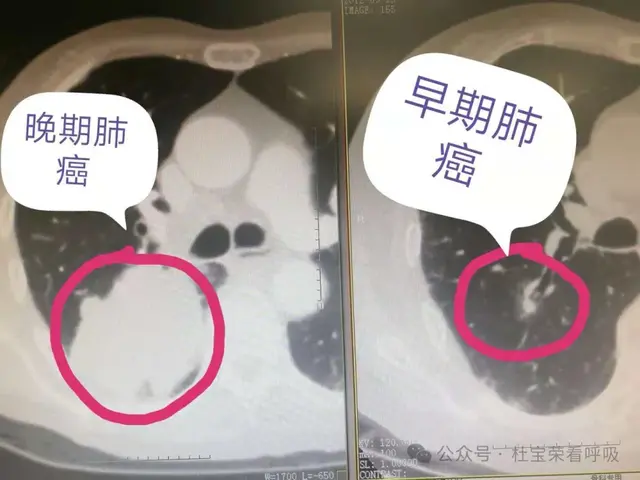 “病从口入”，查出肺结节以后，这些食物就尽量远离，别再碰了！