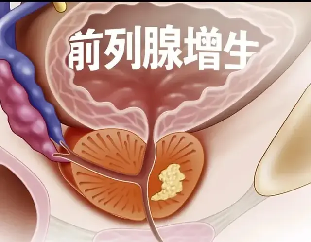 治疗良性前列腺增生的药物坦索罗辛与非那雄胺有什么区别