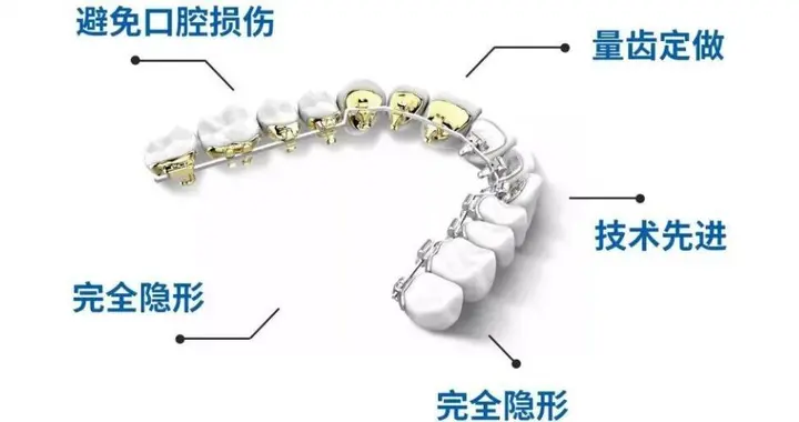 藏在牙齿里的“美学引擎”：eBrace如何实现隐形与精准兼得？