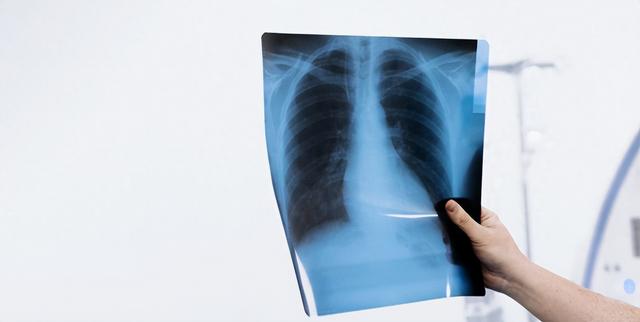 支气管扩张，如果没有出现这五种问题，说明情况还不是很严重！