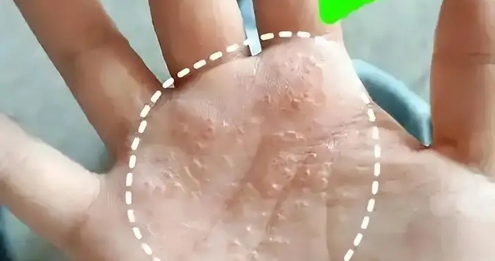 人不会无故患上带状疱疹，研究发现：患带状疱疹，背后有6点原因