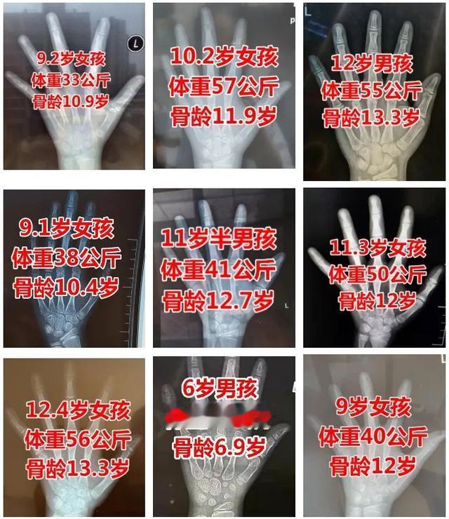 7类食物是骨龄偏大的“帮凶”，孩子越吃越矮小，家长赶紧停下