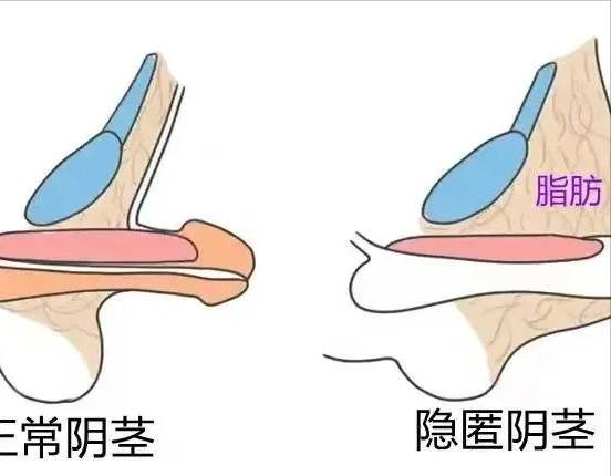 孩子的小丁丁比同龄人短小？家长们看过来~